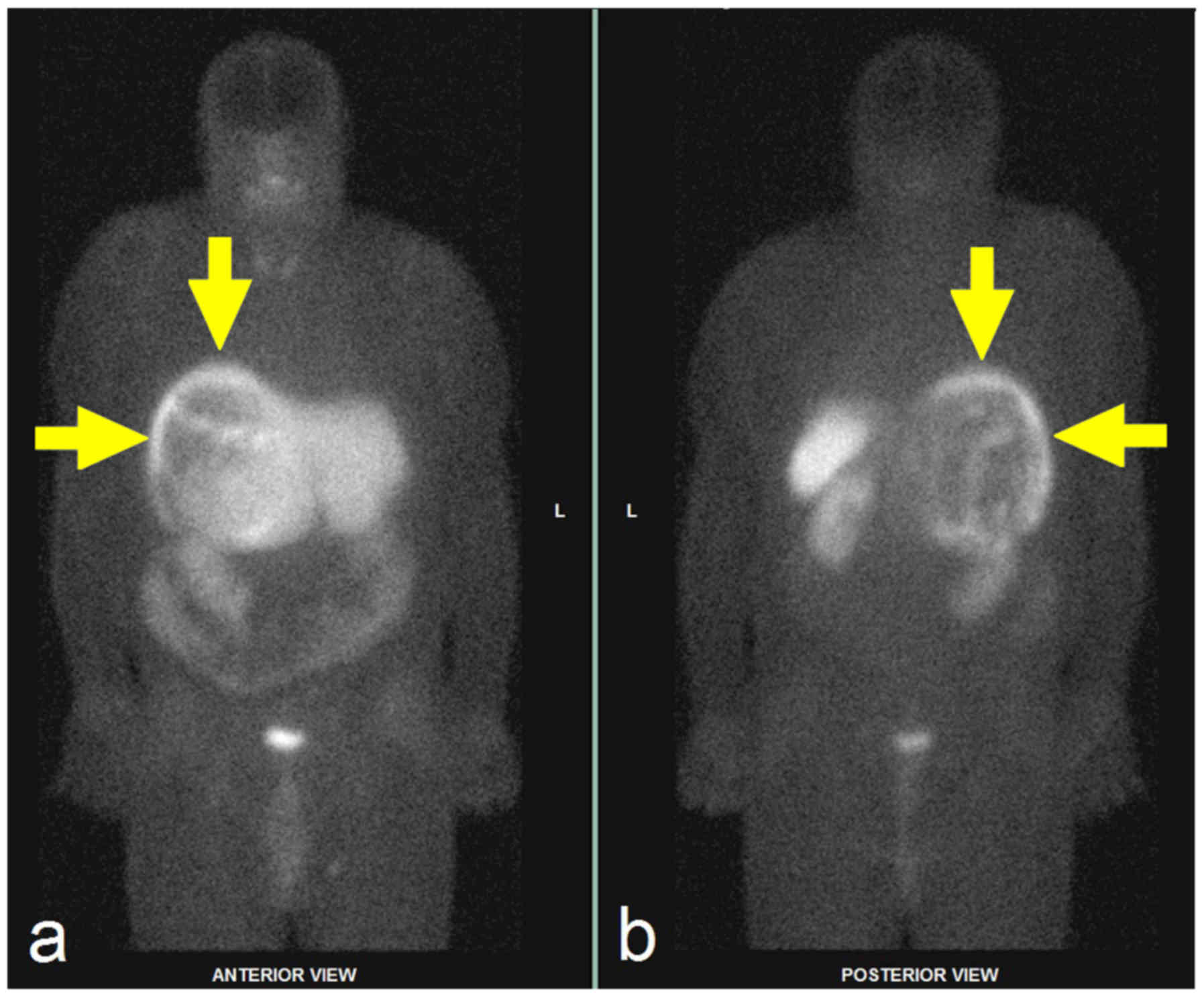99mTc-HYNIC-TOC scintigraphy in a patient with atypical giant paraganglioma