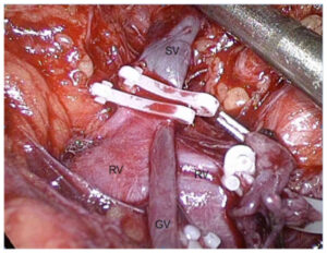 Photograph of a laparoscopic adrenalectomy