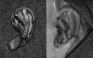 Auricular reconstruction in TCS