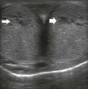 Transverse ultrasound image, ventral view of the penis.