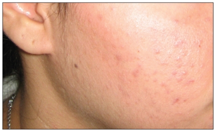 Grade I (mild) acne 