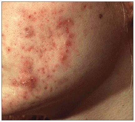 Grade IV (severe) acne 