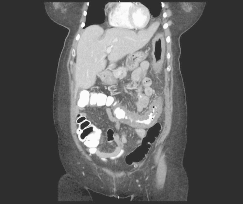 CT scan of coronal sections of the abdomen showing thickening of the splenic flexure, descending colon, and proximal sigmoid colon in a patient with documented ischemic colitis.