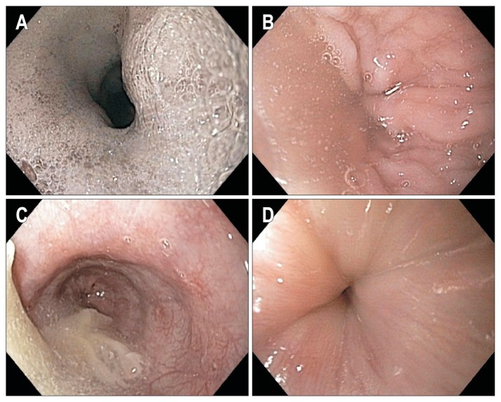 Endoscopic appearance of achalasia
