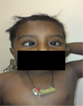 Strabismus in a 2-year-old child with Type 3 Gaucher disease