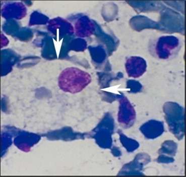 Gaucher cell (arrows) with “crumpled tissue paper” cytoplasm and eccentric nucleus