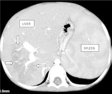 Contrast enhanced CT scan of liver reveals ill-defined minimally enhancing hypodensity in segment 7 of the liver with portal and hepatic venous branches are seen coursing through this lesion (arrows) This represent hepatic infiltration by Gaucher cells. (Gaucheroma)