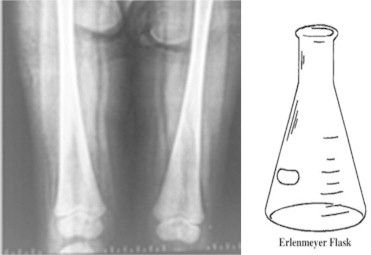 X-ray of the Erlenmeyer Flask deformity of the femora