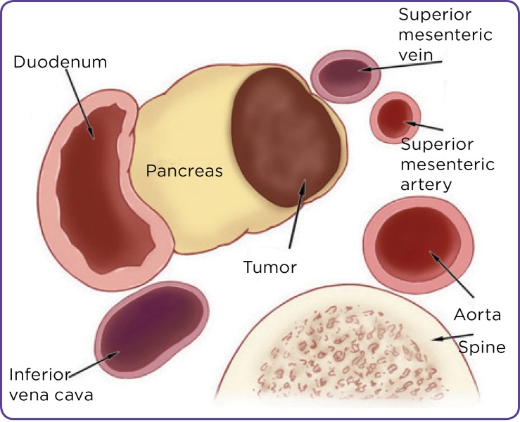Resectable pancreatic cancer