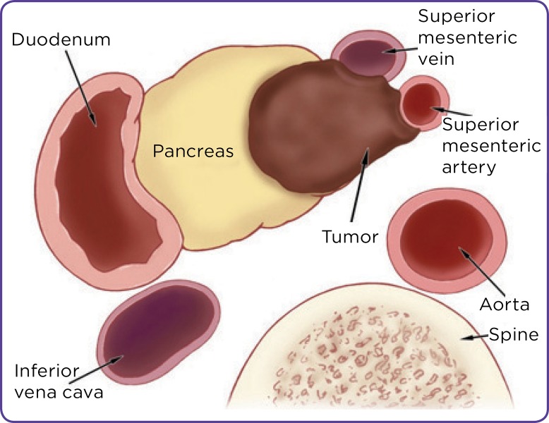 Borderline resectable pancreatic cancer