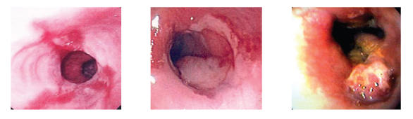Progression of disease, demonstrating changes observed as esophagitis