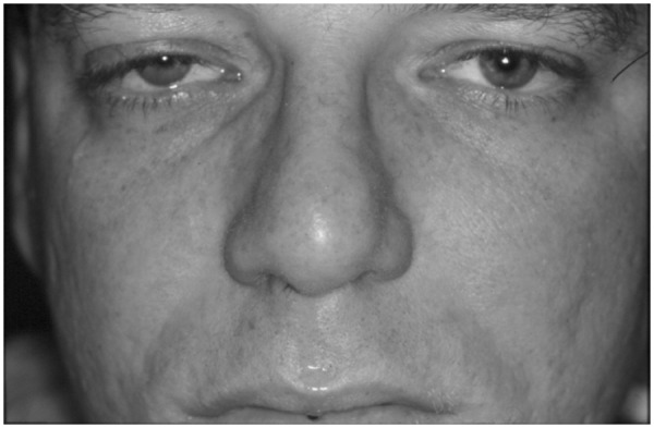 Patient with cluster headache during a right-sided painful attack