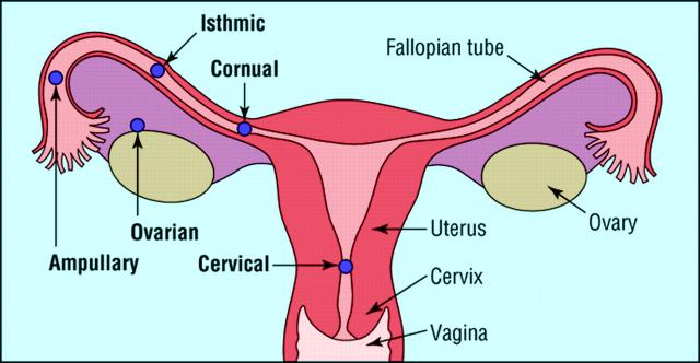 Sites of ectopic pregnancies 