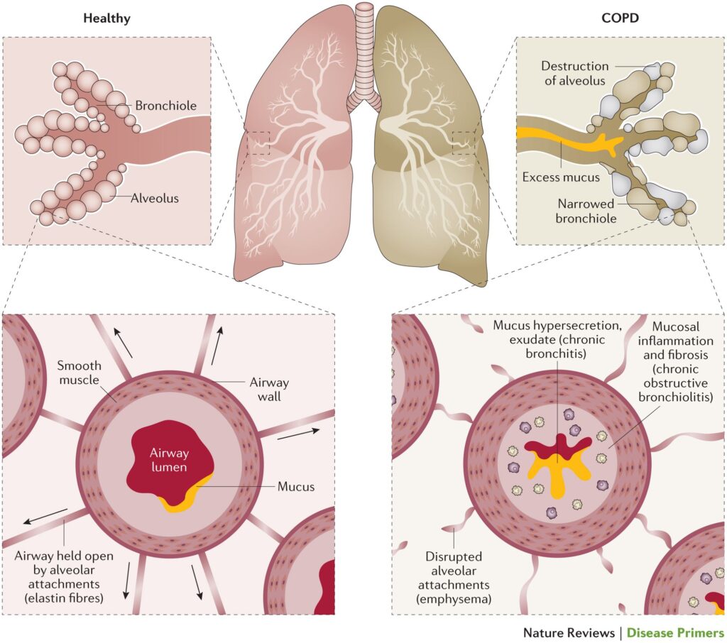 Airway obstruction in COPD