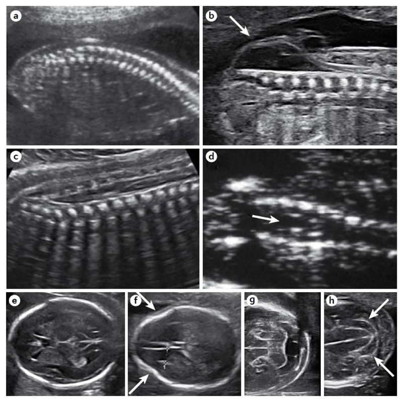 Myelomeningocele and associated cranial signs on ultrasonography