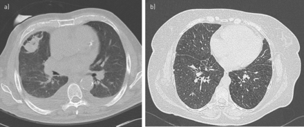Radiology assessment of pulmonary amyloidosis