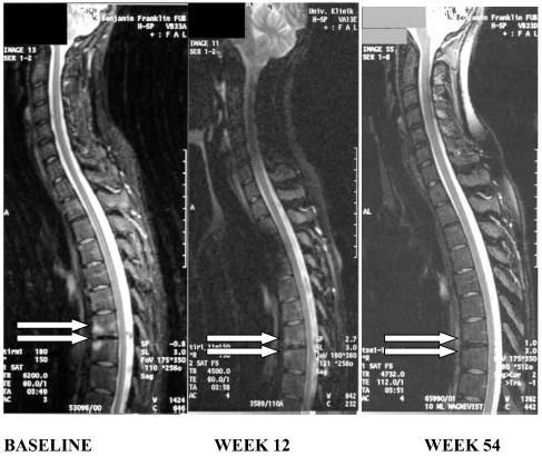 MRI spine in AS