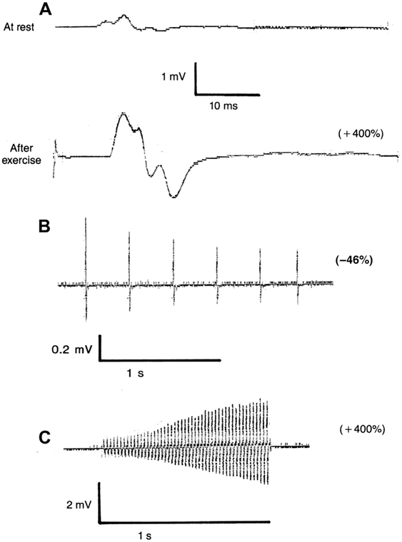 Typical repetitive nerve stimulation pattern in the abductor digiti minimi muscle in LEMS