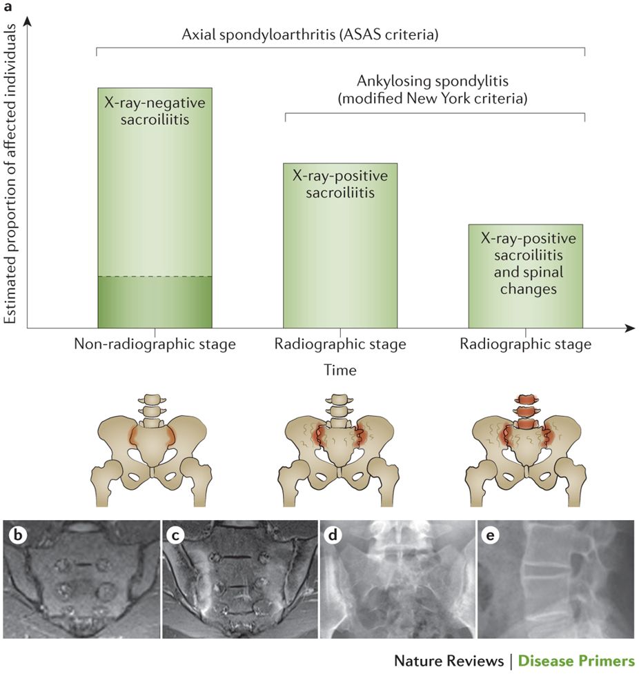 Grouping of axial spondyloarthritis