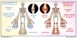 Rheumatoid arthritis (RA) vs osteoarthritis (OA)