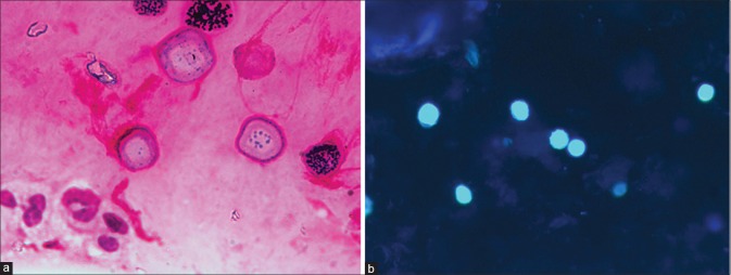 Microscopic features of Acanthamoeba cyst in corneal scraping – Gram stain (a) and calcofluor-white (b). Note hexagonal inner wall of the cysts