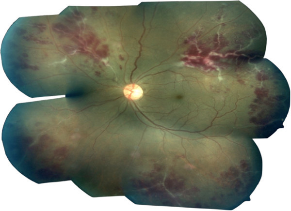 Fundus photograph of Eales' disease with active periphlebitis