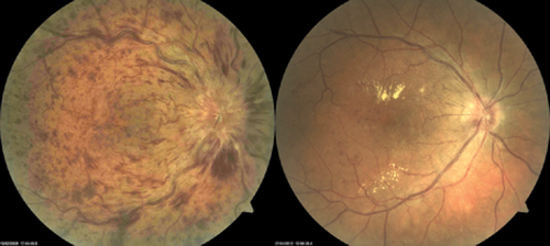Central retinal vein occlusion several months after presentation, pre‐treatment (left) and approximately three years after presentation and following 12 doses of intravitreal bevacizumab (right)