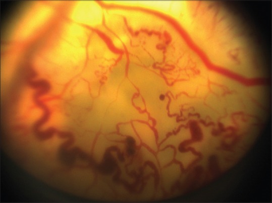 Retinal telangiectasia and subretinal exudation characteristic of Coats disease
