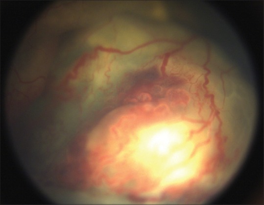 Advanced Coats with total exudative retinal detachment and intraretinal hemorrhage around peripheral telangiectatic vessels