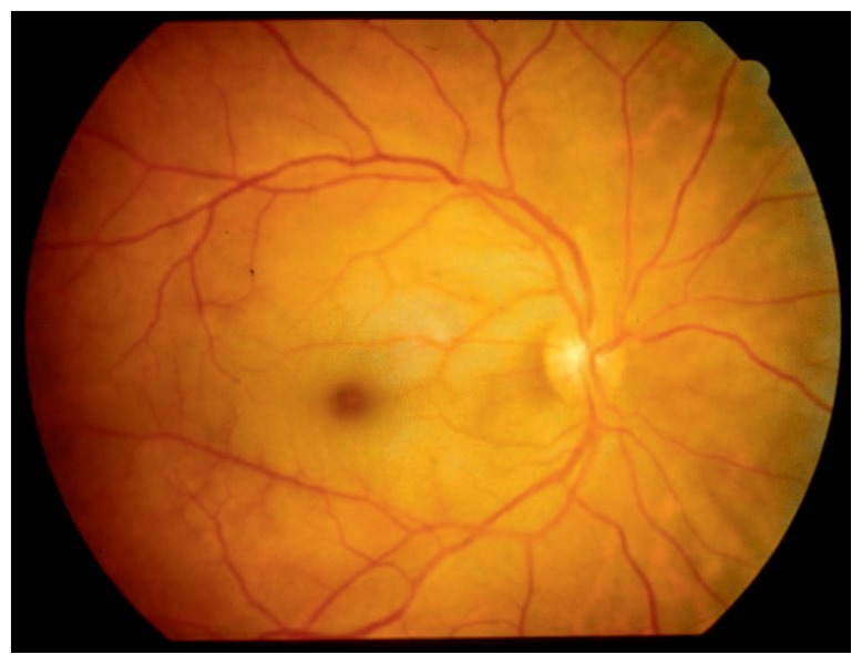 Funduscopic appearance of the classic cherry red spot against the background of retinal whitening in central retinal artery occlusion