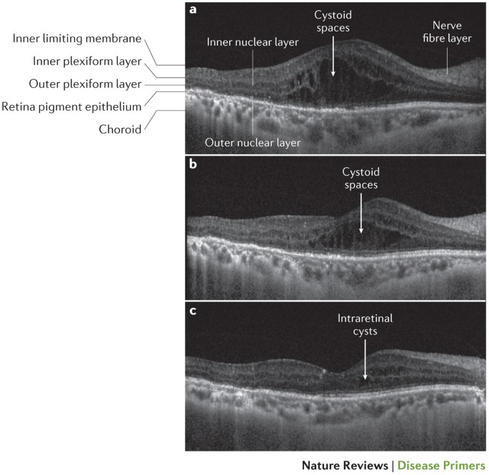 Optical coherence tomography showing treatment outcome for diabetic macular oedema