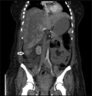 CT in HELLP syndrome showing subcapsular liver hematoma