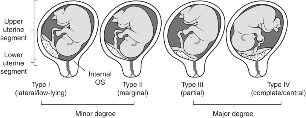 Placental previa classification