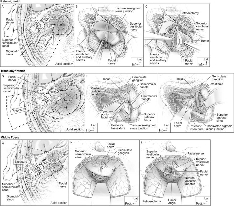 Surgical approaches for VS resection