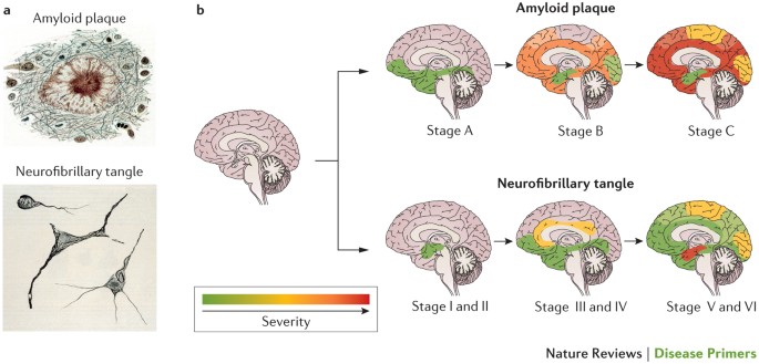 The pathological evolution of Alzheimer's disease