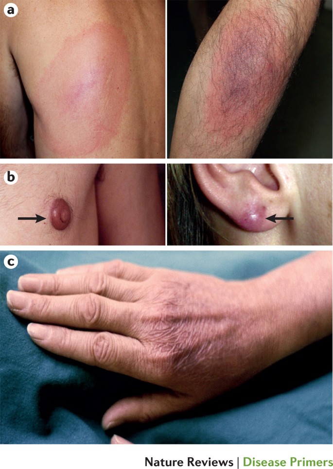 Dermatological manifestations of Lyme borreliosis
