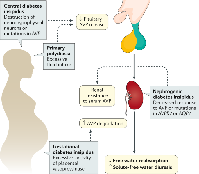 Pathophysiology of DI