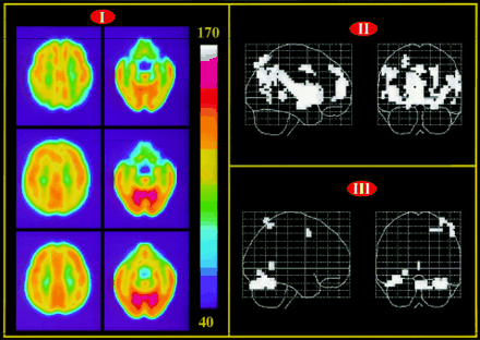 Tc-99m HMPAO SPECT in the evaluation of Alzheimer’s disease