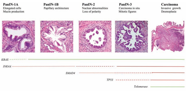 Precursor lesions of pancreatic cancer: pancreatic intraepithelial neoplasia (PanINs)