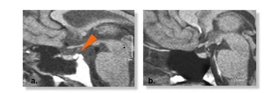 MRI Appearance of Posterior Pituitary in Hypothalamic/Cranial DI