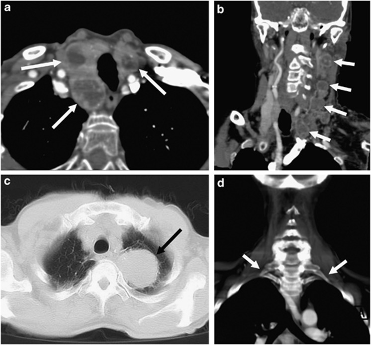 Second-order neuron lesions on CT angiography (CTA)