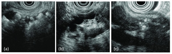 Endoscopic ultrasound images characterizing features of chronic pancreatitis