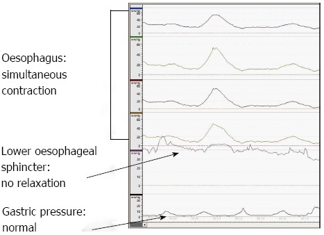 Oesophageal manometry demonstrating simultaneous contractions within the oesophagus and a non-relaxing lower oesophageal sphincter