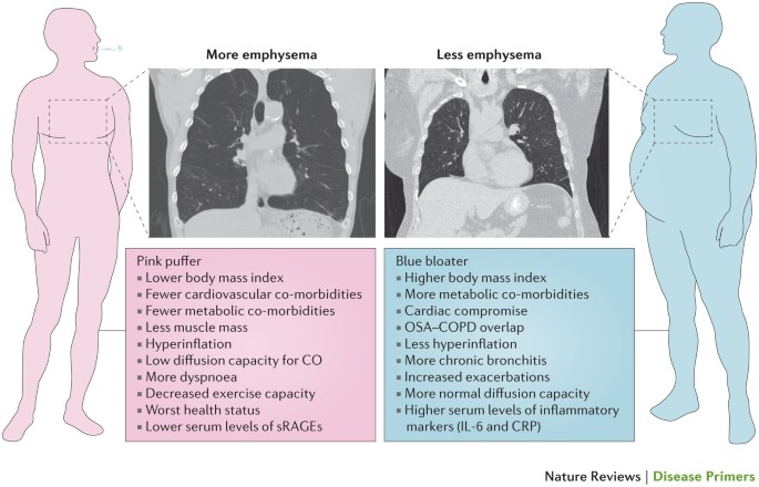 Clinical and radiological characteristics of the classic phenotypes of patients with COPD