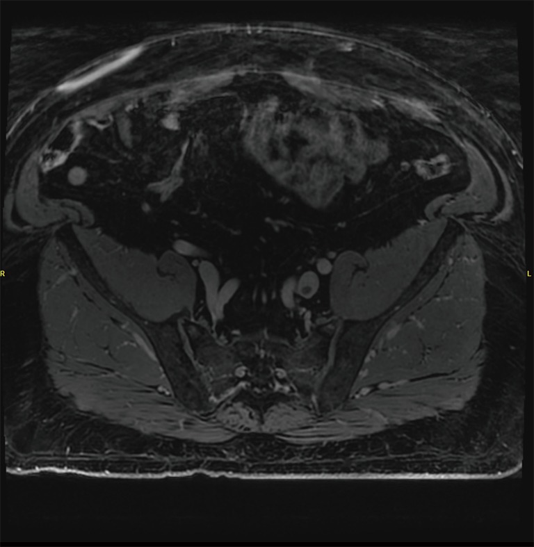 MR venography. MR imaging demonstrating a focal thrombus in the left common iliac vein that was seen extending superiorly to the inferior vena cava. No thrombus is seen on the contralateral side. + MR, magnetic resonance.
