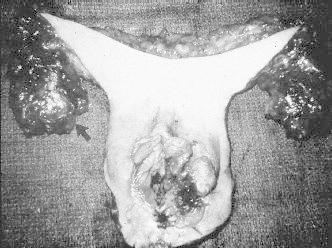 Gross vulvectomy specimen showing a vulvar carcinoma