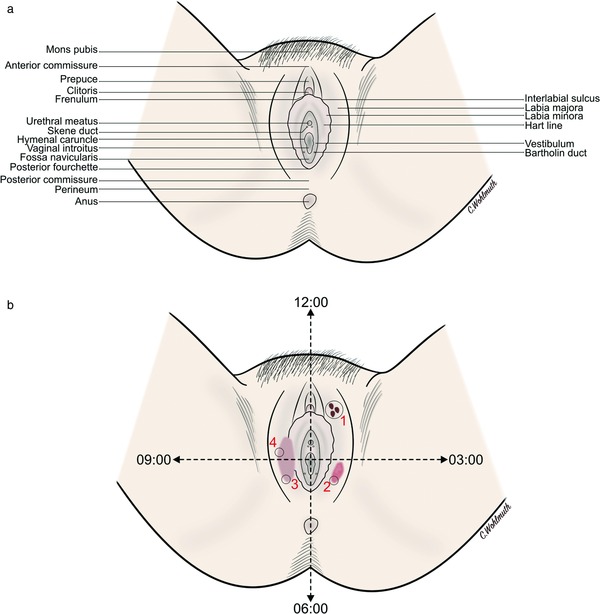 Vulvar anatomy and mapping of lesions