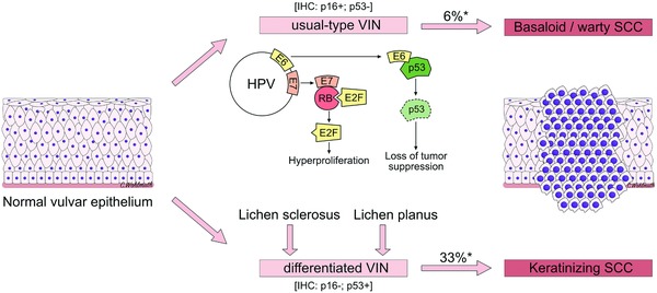 Pathophysiology of usual‐type and differentiated VIN and its progression to SCC
