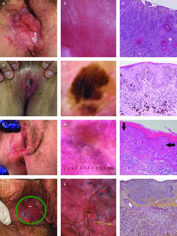 Macroscopic, dermoscopic and histopathologic features of vulvar malignancies