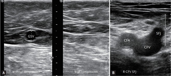 Sonographic landmark of superficial femoral veins